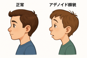 口呼吸と歯並びの関係イメージ